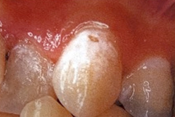 穴があいていない初期虫歯では、レーザーによる歯質強化が効果的です。