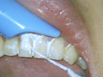 POICオフィスプレミアム治療 ～新しい歯周病治療～（１日で感染物質や歯周病原菌を除去）